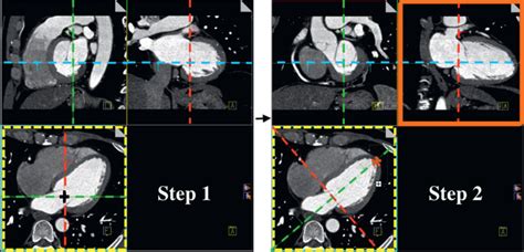 Fixed Core CT