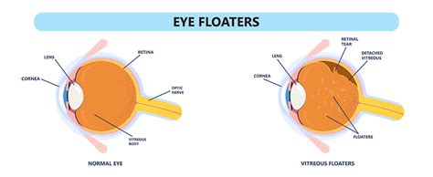 Floaters at a young age Neuroptometry