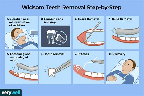 Flossing after wisdom tooth removal - Ask Me Help Desk