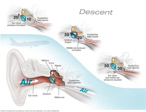 Flying with congested eardrums : flying - Reddit