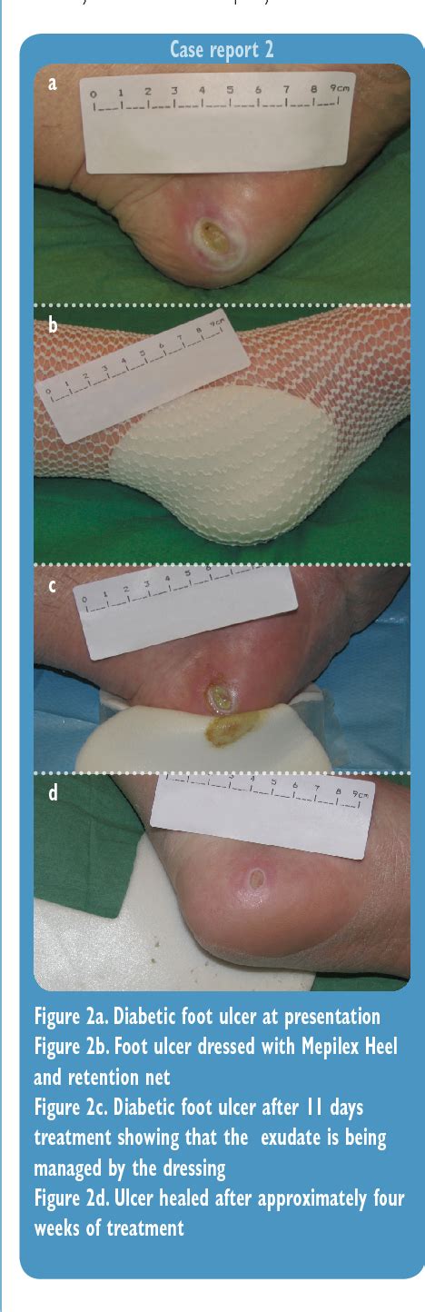 Foam dressings for healing diabetic foot ulcers - PubMed