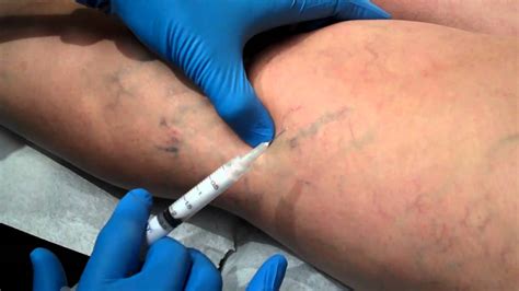 Foam sclerotherapy for varicose veins - a patient