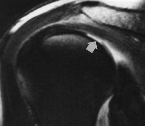 Focal Articular Cartilage Lesions of the Superior Humeral Head