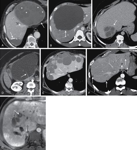 Focal Liver Lesions - PubMed