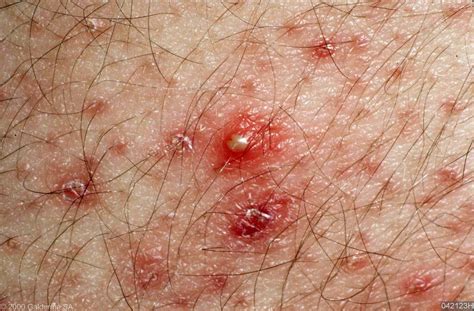 5. Genital folliculitis. It is caused by Staphylococcus aureus and occurs mainly in the groin or the genital area. These lesions formed in the pubic area may be filled with pus. This is usually difficult to cure due to its awkward location ….