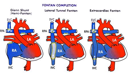 Fontan手術 meddic