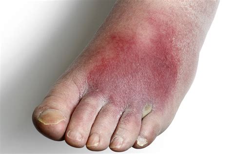 Foot cellulitis icd 10. foot - see Cellulitis, lower limb; gangrenous - see Gangrene; genital organ NEC. female N76.4 (external) ... ICD-10-CM Diagnosis Code L03.316. Cellulitis of umbilicus. 