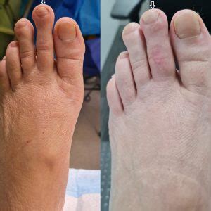 Foot shortening surgery.  Our expert team ensures Recovery Process Post-Surgery Ca...
