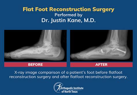 Foot transformation.  Flat foot reconstruction surgery can restore mobil...