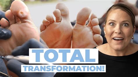 Foot transformation.  In this full-length procedure, we perform a complete foot transfo...