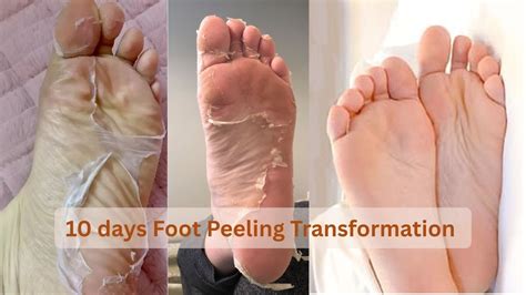 Foot transformation.  Use of numerous other skin procedures, varied due to ...