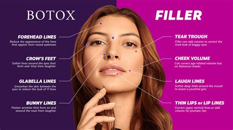 Forehead Botox Price Philippines