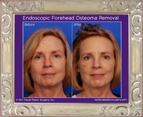 Forehead Osteoma Removal Covered By Insurance