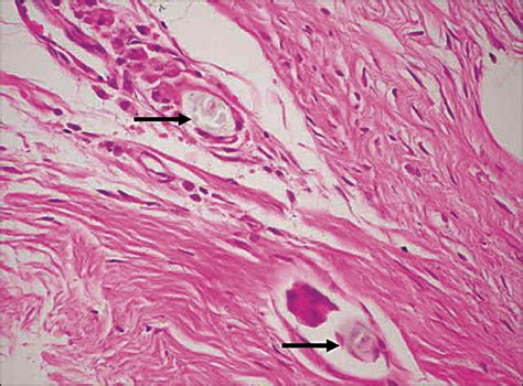 Foreign-body giant cell - Wikipedia