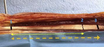 Fractional Lengthening of the Forearm Flexor Muscles: Anatomic …