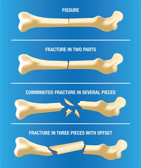 Fracture Help Center