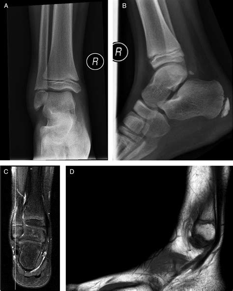 Fracture left foot icd 10. S92.145A is a billable/specific ICD-10-CM code that can be used to indicate a diagnosis for reimbursement purposes. Short description: Nondisplaced dome fracture of left talus, init for clos fx; The 2024 edition of ICD-10-CM S92.145A became effective on October 1, 2023. 