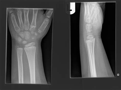 Fracture of right hand icd 10. S52.601A is a billable/specific ICD-10-CM code that can be used to indicate a diagnosis for reimbursement purposes. Short description: Unsp fracture of lower end of right ulna, init for clos fx; The 2024 edition of ICD-10-CM S52.601A became effective on October 1, 2023. 