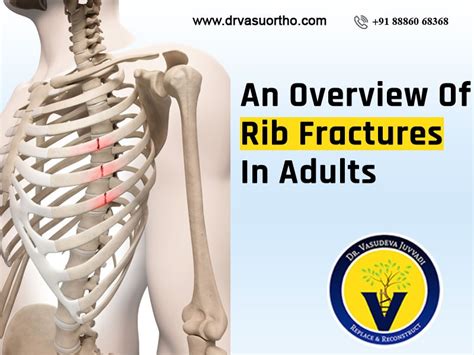 The ICD code S224 is used to code Rib fracture. A rib fracture is a break or fracture in one or more of the bones making up the rib cage. Fractures of the first and second ribs may …. 