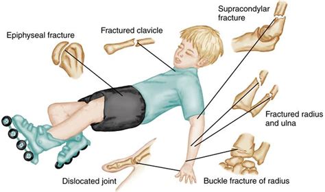 Fractures - Children’s