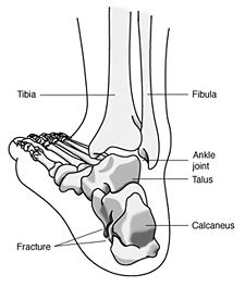 Fractures of the Heel UConn Musculoskeletal Institute