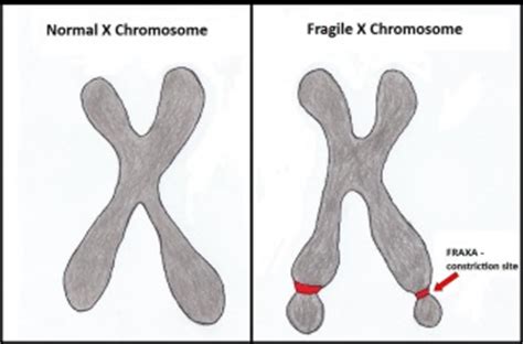 Fragile X Syndrome - Embryology - UNSW Sites