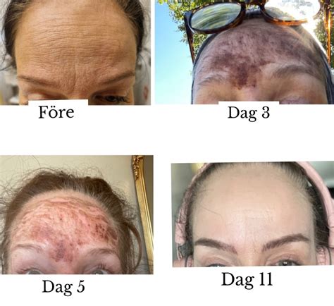 Fraktionerad laser biverkningar