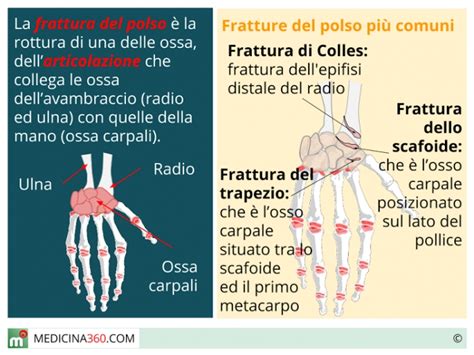 Frattura polso: tipi, sintomi, terapia, intervento e …