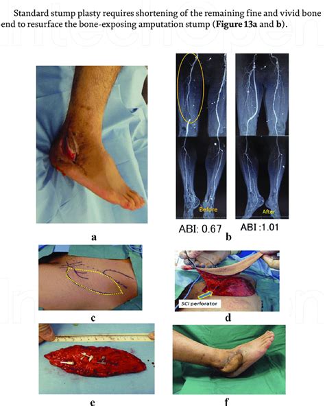 Free Flap in osteomyelitis