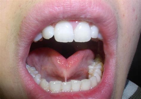 The others are located under your tongue and underneath your upper lip. People with vulvas have frenula in their genitals as well. Though relatively small, the frenulum is the most sensitive and... 