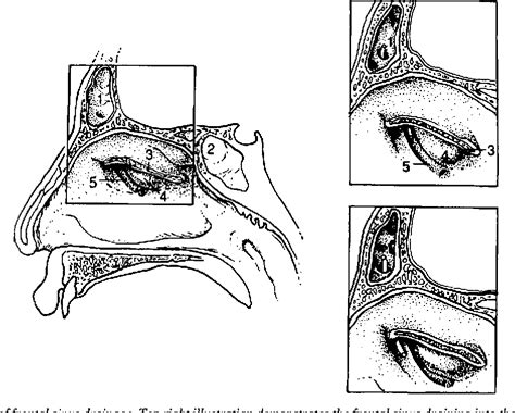 Frontal sinus outflow anatomy - PubMed