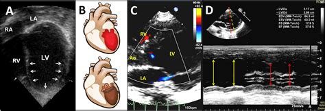 Frontiers Catecholamine-Induced Secondary Takotsubo …