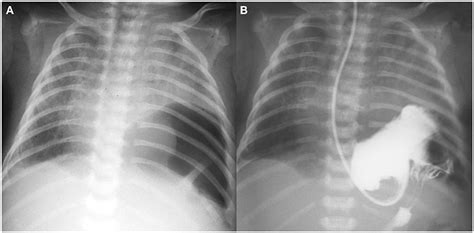 Frontiers Rare Course of Bilateral Congenital Diaphragmatic …