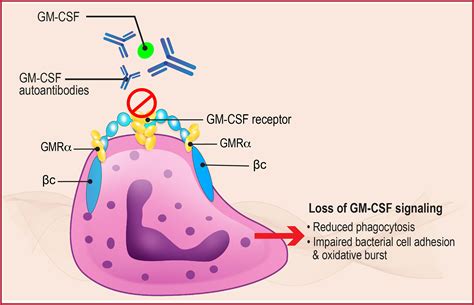 Frontiers The Role of GM-CSF Autoantibodies in Infection and ...