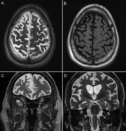 Frontotemporal lobar degeneration Radiology …