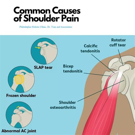 th?q=Frozen shoulder - Symptoms and causes - Mayo Clinic