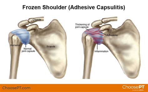 Frozen shoulder gurkmeja