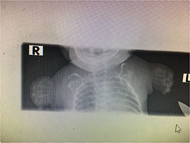 Fucking armless.  Phocomelia is a congenital disorder that involves malformations of ...