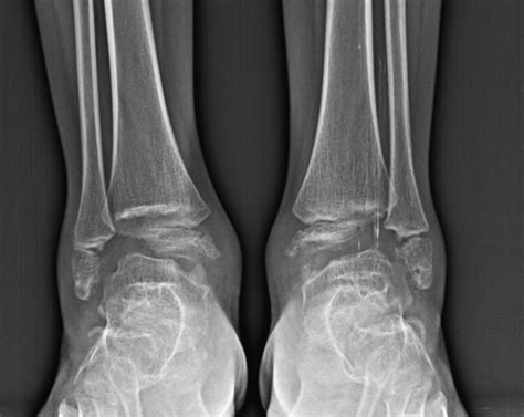 Full article: Multiple epiphyseal dysplasia - Taylor & Francis