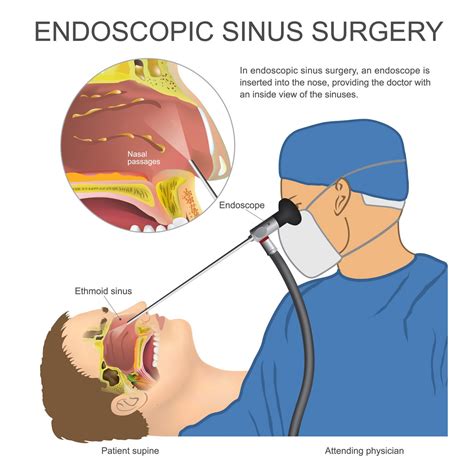 Functional endoscopic sinus surgery