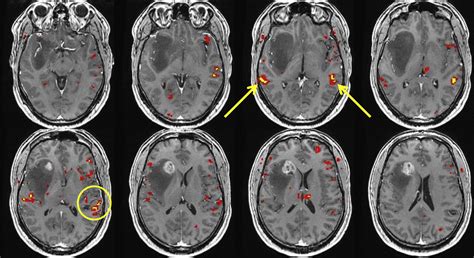 For fMRI, the same things happen as with MRI – the energy emitted from the relaxation of protons is measured – but the calculations are instead aimed at determining how the amount of oxygenated blood flow changes. If there is more oxygenated blood in one part of the brain compared to others, then chances are that this brain area is more .... 