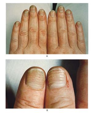 Fungal Nail Disease NEJM - New England Journal of Medicine