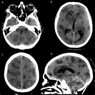 Fungal brain infections - PubMed