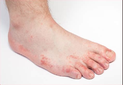 Fungal skin infection - foot Health topic…