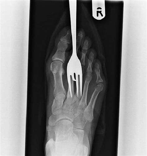 Funny x rays photos. It’s like they have this irresistible urge to gulp up really strange stuff. Lets take a look at some funny radiology pictures. 10. A Several Inch Long Nail. We all know what nails are used for; joining pieces of wood together or fastening iron sheets to wood when roofing a house. Apparently, not all of us know that. 