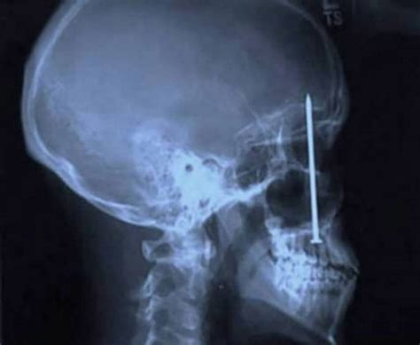 Funny xray pictures. Things To Know About Funny xray pictures. 