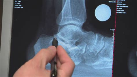 Fusing a foot bone: A look at the surgery that sidelined Tiger Woods