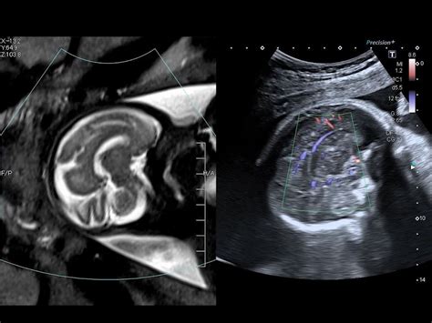 Fusion imaging in ultrasound
