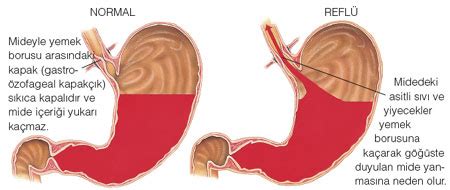 Göğüste yanma hissi .