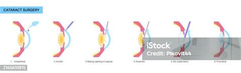 Gambar Katarak, Stok Foto, dan Background - Pngtree - balustradellc